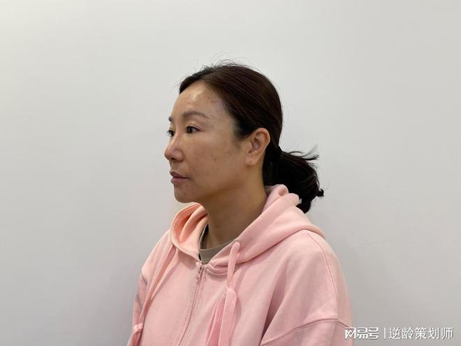 如何挑选适合自己的拉皮专家？面部提升修复案例黄金期饮食(图1)